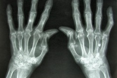 Welt-Rheumatag 2026